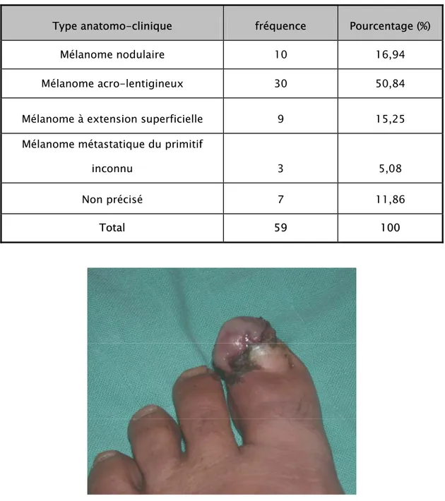 Tableau IX : Répartition de mélanome selon le type anatomo-clinique.  Type anatomo-clinique  fréquence  Pourcentage (%) 