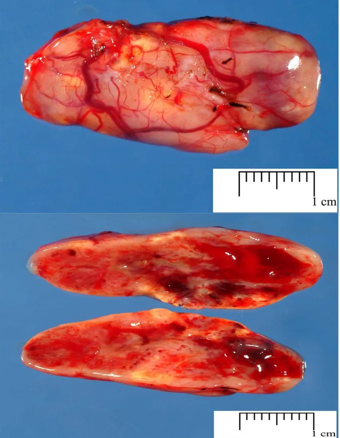 Figure 13 : aspect macroscopique du schwannome avec sa capsule très vascularisée