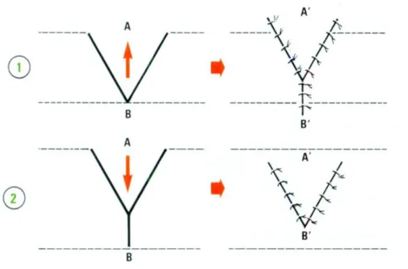 Figure 10 : (1)=Plastie en VY ;   (2)=Plastie en YV 