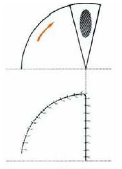 Figure 11 : Lambeau de rotation simple. [19] 