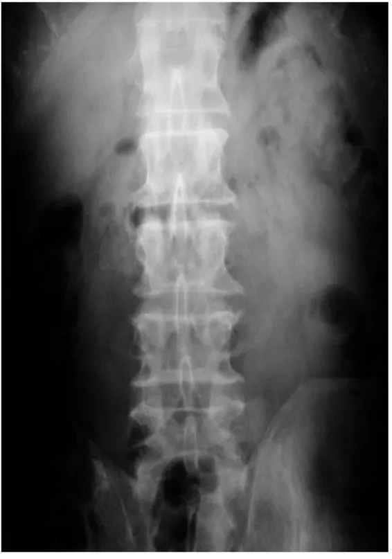 Figure 5: Radiographie de face lombo-sacré   montrant des signes d’arthrose