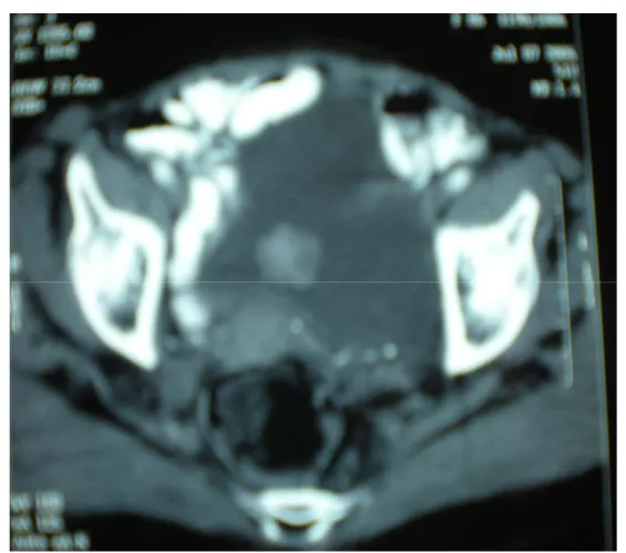 Figure 9: Uroscanner montrant une tumeur ronde au niveau du dôme vésical. 