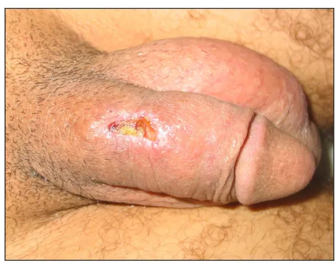 Figure 11: Granulome tuberculoïde sous forme d’un nodule  de la verge chez un patient traité par BCG thérapie