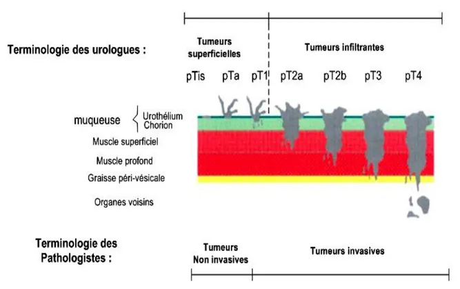 Figure 12: Représentation  schématique  des stades pT, selon la classification pTNM (UICC1997) 