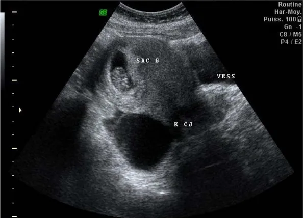 Fig 6: Image échographique objectivant un sac gestationnel extra-utérin unutérus vide et un  kyste du corps jaune