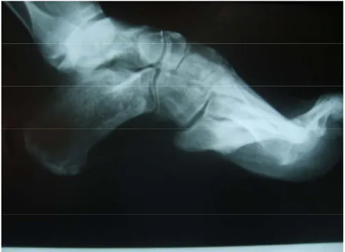 Figure 4 : Radiographie du  pied profil d’un patient présentant un PBVEC invétéré 