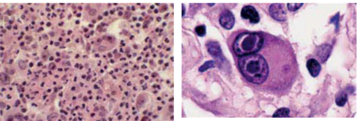 Figure n°5 :  Maladie de Hodgkin classique : présence de cellules anormales de type Hodgkin et Reed-