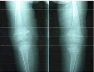 Figure 1: Radiographies des deux genoux objectivant des signes du rachitisme. 