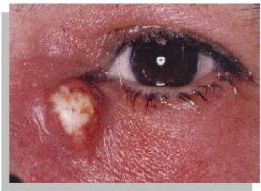 Figure 11: Abcès du sac lacrymal 