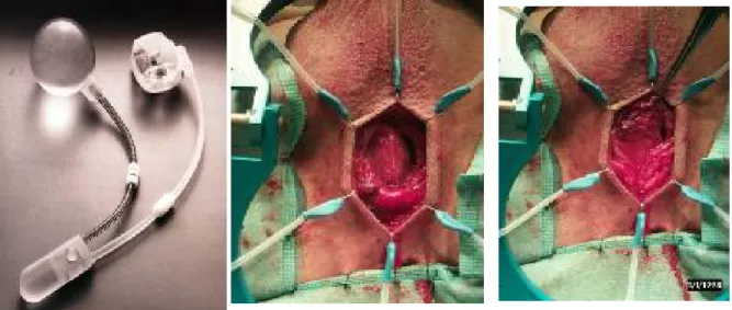 Fig. 1 : photos montrant les différentes étapes chirurgicales de placement de  sphincter urinaire artificiel