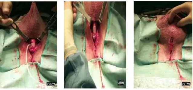 Fig. 2 : photos montrant les différentes étapes chirurgicales de placement de sphincter  urinaire artificiel