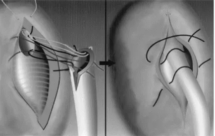 Fig. 5 : schéma montrant les points de suture et la création d’un tunnel sous muqueux