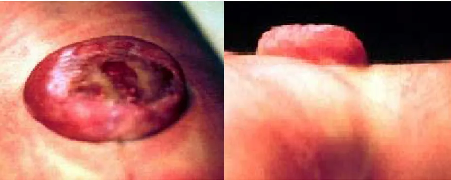 Fig. n°4 : vue de face et de profil d’une MMC en cocarde. (19) 