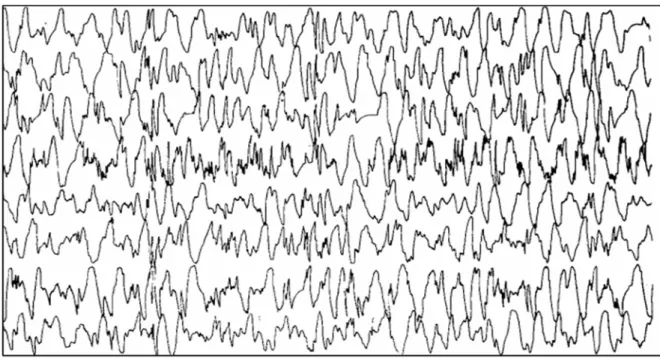 Figure n°6 : Hypsarythmie typique chez un nourrisson de 5 mois 