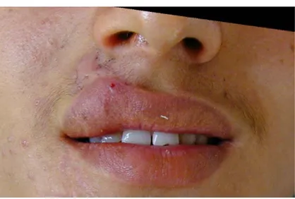 Fig 16 : cicatrice rétractile de la lèvre supérieure 