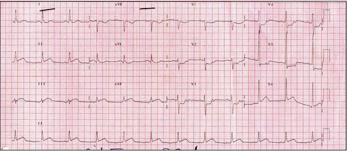 Figure 6: Aspect ECG d’un IDM inférieur (sus décalage ST en D2 D3 aVF). 