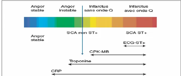 Figure 10 : Nouvelle classification des Syndromes Coronariens Aigus. Relation clinique,  électrique et marqueurs de la nécrose myocardique [2]