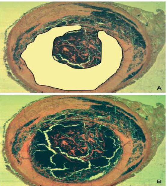 Figure 11 : Physiopathogénie de la thrombose sur rupture de plaque. [2] 