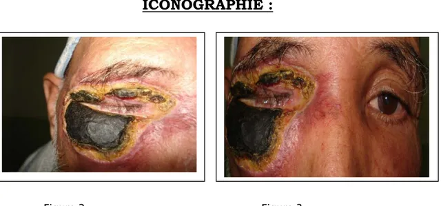 Figure  4: Aspect clinique à 4  semaines : 