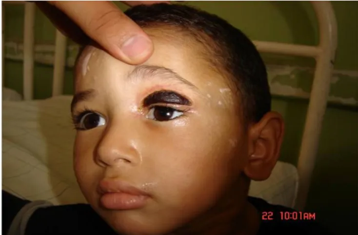 Figure 6: Escarre nécrotique de la paupière supérieure de l’œil gauche chez un enfant de 9 ans