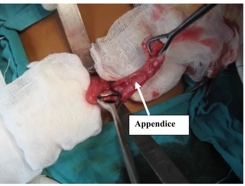 Figure 8 : Photo per opératoire montrant une appendicite catarrhale 