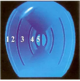 Figure 13 : Aspect biomicroscopique des bandes de discontinuité du cristallin (5)                                  1- Capsule + épithélium ; 