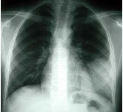 Fig. 1: Radiographie thoracique de face montrant une opacité basale gauche à contours  réguliers