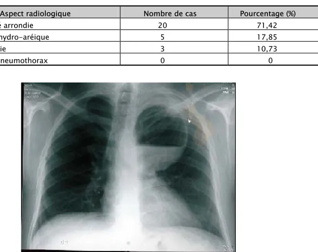 Tableau V : Les différents aspects radiologiques 