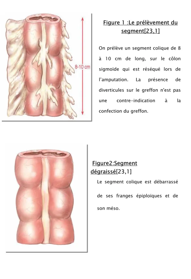 Figure 1 :Le prélèvement du  segment[23,1] 