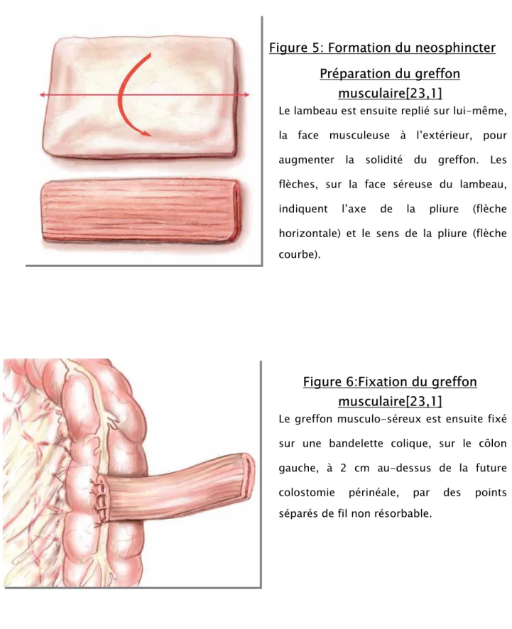 Figure 6:Fixation du greffon  musculaire[23,1] 
