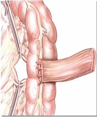 Figure 8:Manchonnage du  côlon[23,1] 