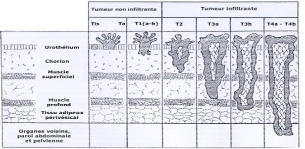 Tableau II : Nouvelle classification de différenciation cellulaire (OMS 2004) 