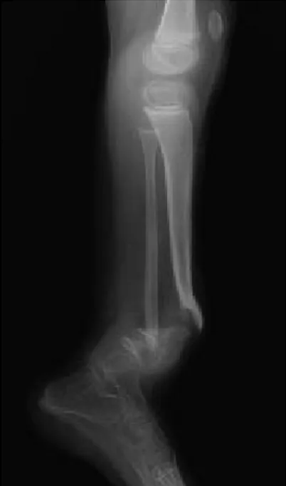 Fig. 11. 12 : Pseudarthrose congénitale de jambe : courbure congénitale du tibia chez  un  garçon de 5 mois [24] 