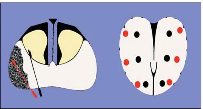 Figure 10 : Le protocole à 6 biopsies (points noirs correspondant à l’aiguille noire)  manque environ 15 % de tumeurs développées dans la partie latérale de la ZP