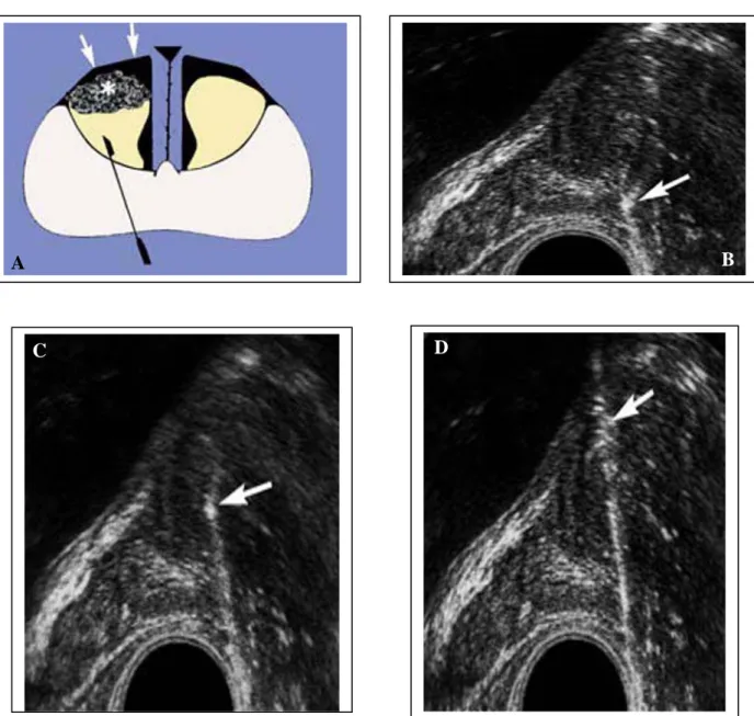 Figure 11: A : Le cancer (*) est développé très en avant, profondément dans la ZT, derrière le  stroma fibromusculaire antérieur (flèches)