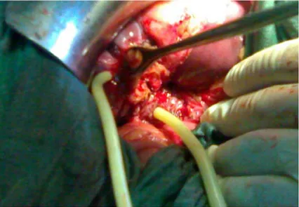 Fig 8 : Image opératoire d’une cholédocostomie transhépatico-kystique selon Perdomo  7-2- Traitement radical : 