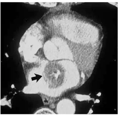 Figure 5 : une coupe scannographique objective un myxome  de l’atrium gauche 