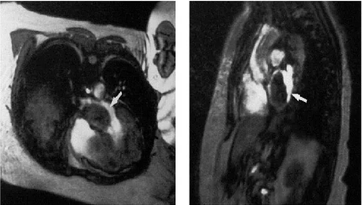Figure 6 : angio-IRM montrant un myxome de l’atrium gauche. 