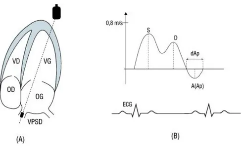 Figure 7: examen échodoppler du flux veineux pulmonaire (FVP) 
