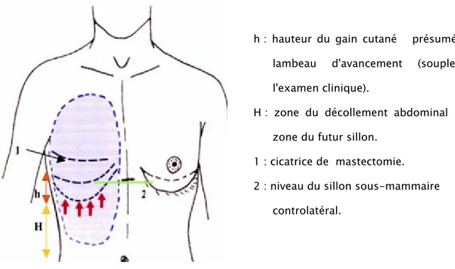 Figure n° 12: Schéma du Lambeau abdominal avancé [34]. Le tracé préopératoire: 