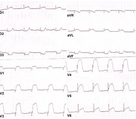 Figure 4 : Un sus décalage du segment ST avec aspect en dôme de PARDEE 