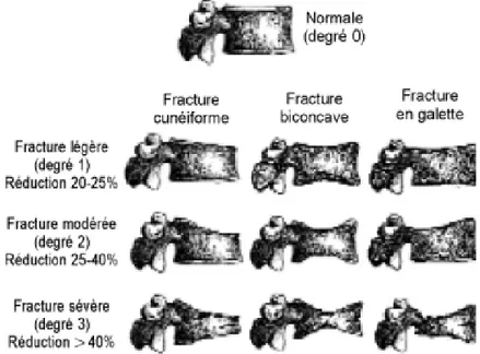 Figure 4  :  diagnostic de fracture vertébrale : méthode visuelle semi-quantitative 