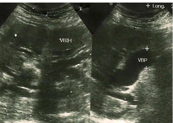 Figure  3b : empierrement cholédocien avec dilatation des voies biliaires intra et extra-hépatique 