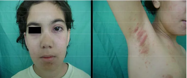 Figure 2 : conjonctivite purulente (photo gauche) et mycose axillaire (photo droite) chez une fille  atteinte de LED 