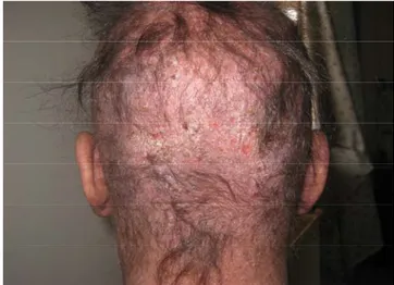 Figure 9 : alopécie cicatricielle (lupus discoïde) 