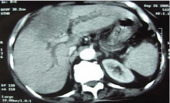 Fig 9:Tomodensitométrie abdominale montrant un envahissement tumoral des segments IV et V