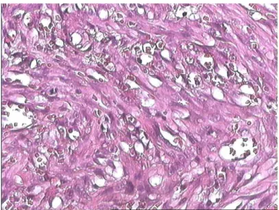 Figure 24 : Angiosarcome de Kaposi avec ses 2 contingents ;   cellulaire fusiforme et vasculaire (HE×20) 