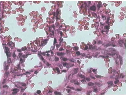 Figure 27 : Angiosarcome cutané bien différencié ;   cellules endothéliales à noyau volumineux hyperchrome (HE×40) 