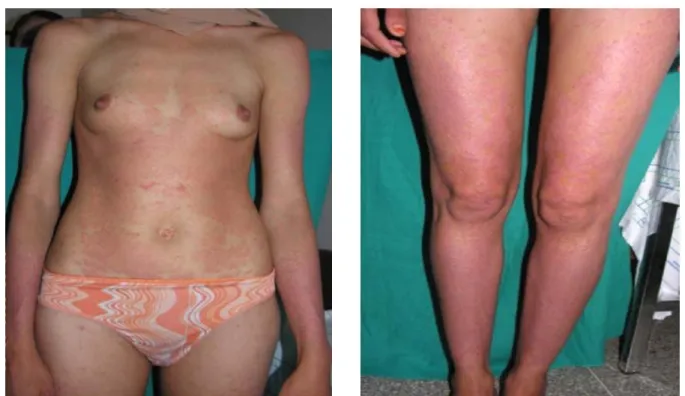 Fig 23 : Psoriasis en plaque (PASI initial= 22) 