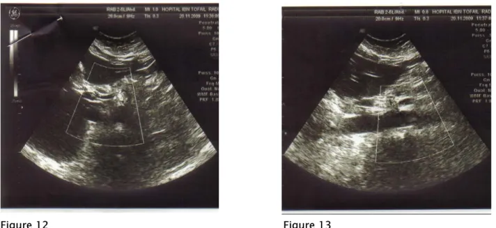 Figure 12 et 13 : Echographie abdominale avec doppler montrant un thrombus pariétal de l’aorte  abdominale sus rénal étendu au tronc coeliaque 